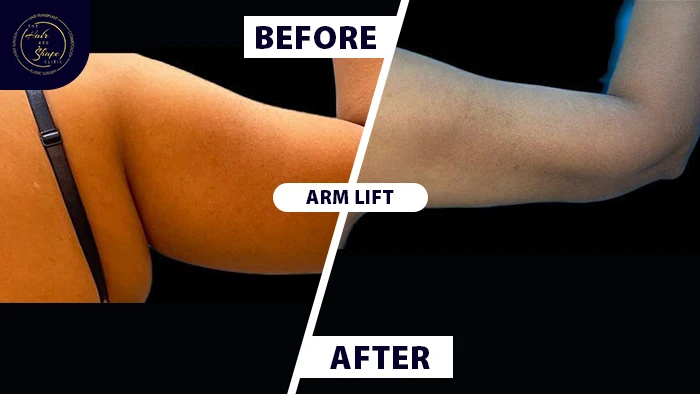 Arm lift before & after