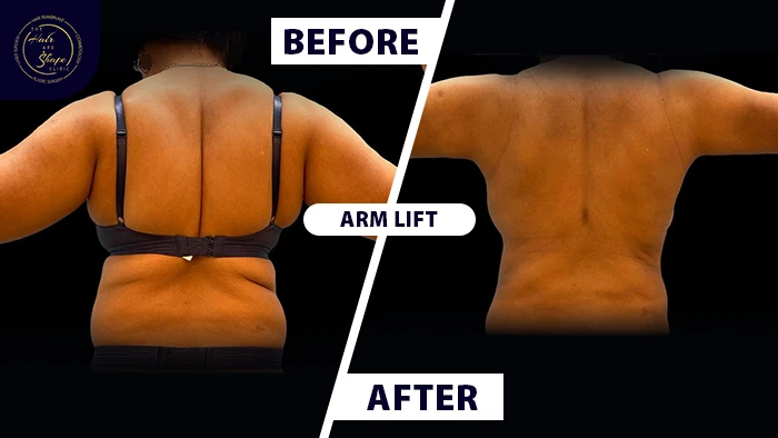Arm lift with back liposuction before & after