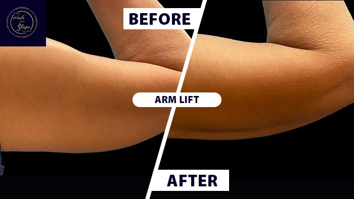 Arm lift before & after