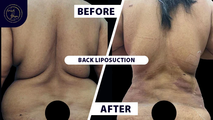 Back liposuction before & after