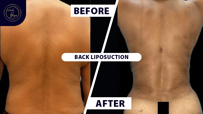 Back liposuction before & after