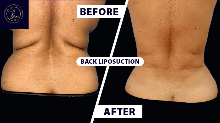 Back liposuction before & after
