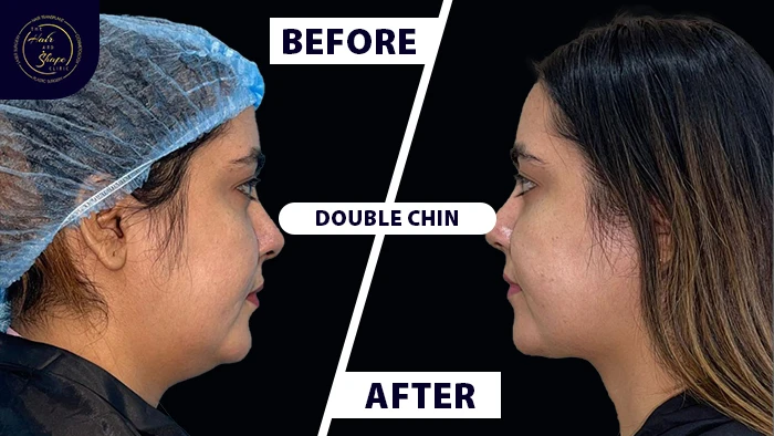 Double chin before & after
