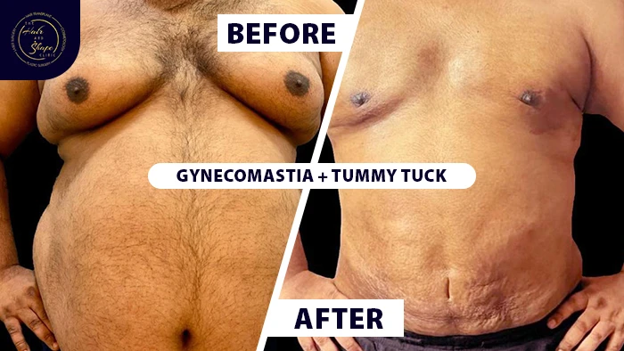 Double chin before & after