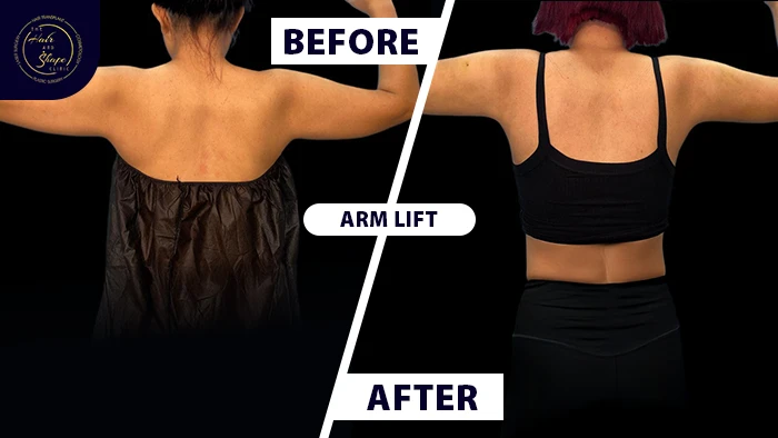 Double chin before & after