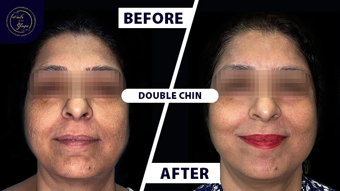 Double chin before & after
