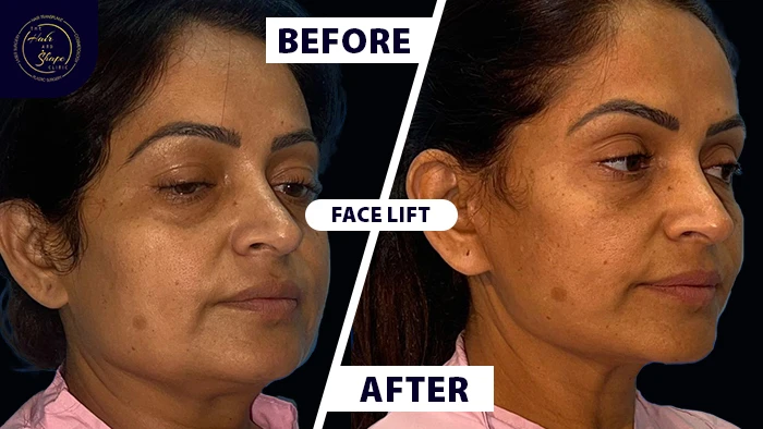 Face lift before & after