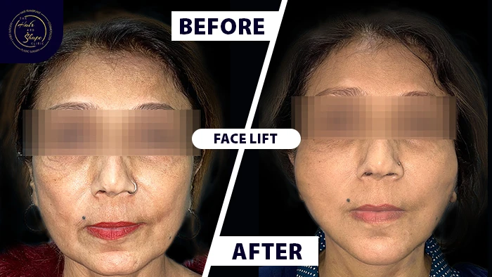 Face lift before & after