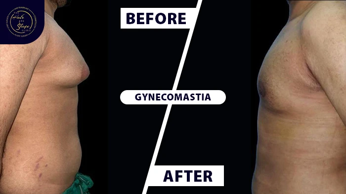 Gynecomastia before & after