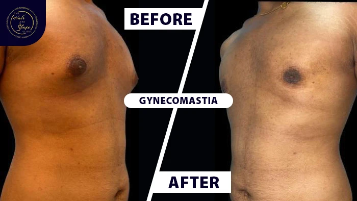 Gynecomastia before & after