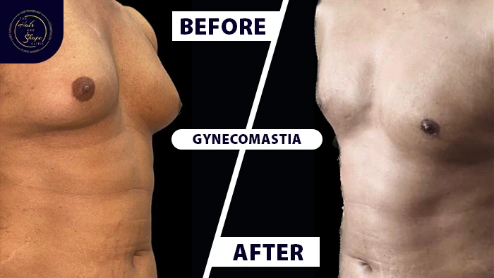 Gynecomastia before & after