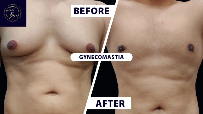Gynecomastia before & after