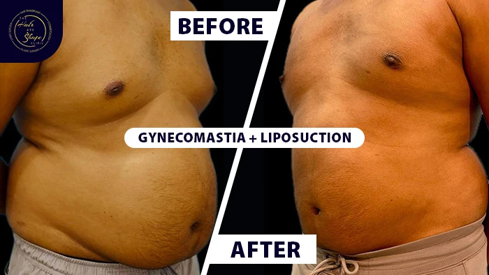 Gynecomastia liposuction before & after