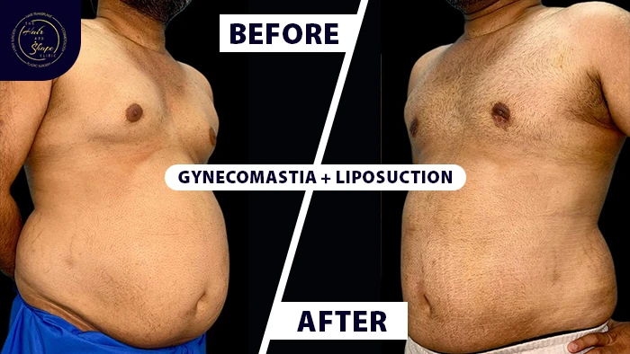 Gynecomastia liposuction before & after