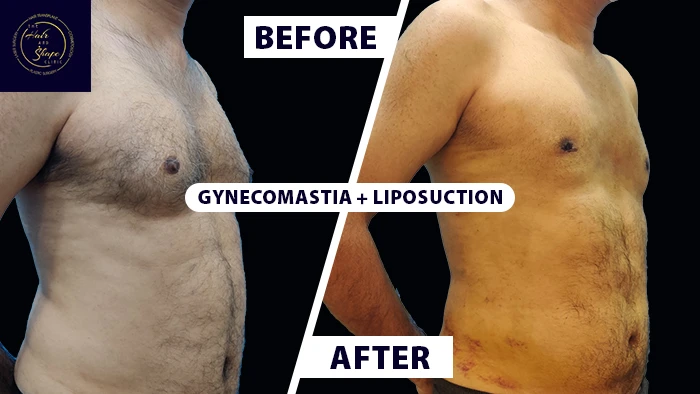 Gynecomastia liposuction before & after