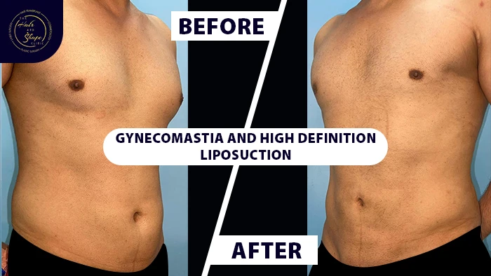 Gynecomastia with high definition liposuction before & after