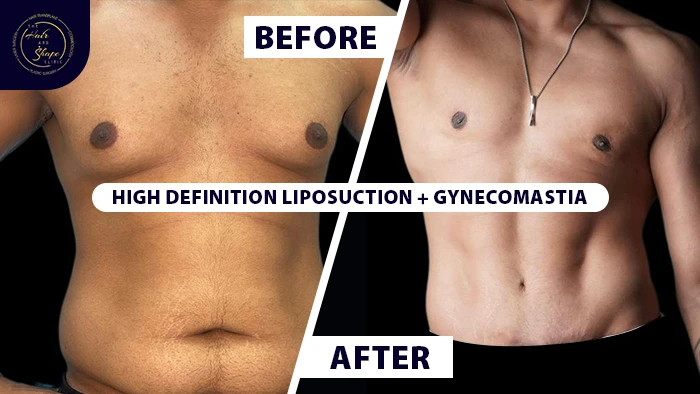High definition liposuction with gynecomastia before & after