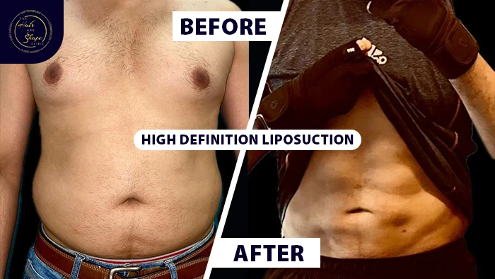 High definition liposuction before & after
