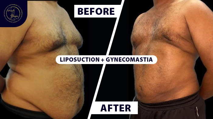 Liposuction with gynecomastia before & after