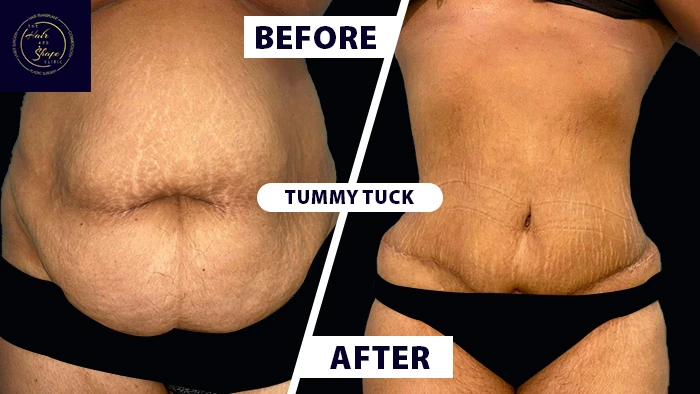 Tummy tuck before & after