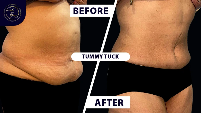 Tummy tuck before & after