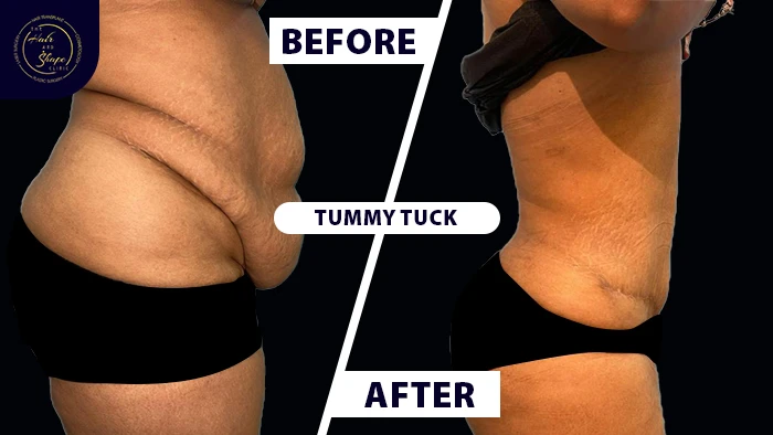 Tummy tuck before & after