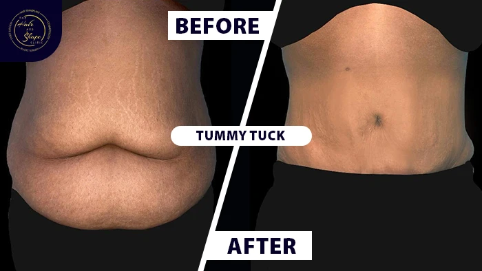 Tummy tuck before & after