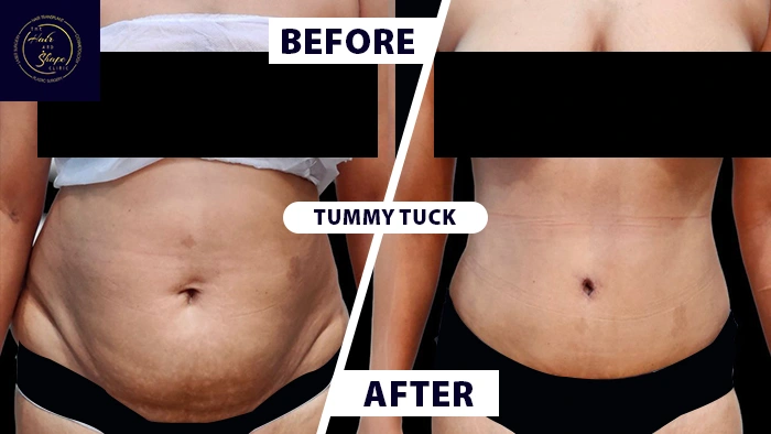 Tummy tuck with back liposuction before & after