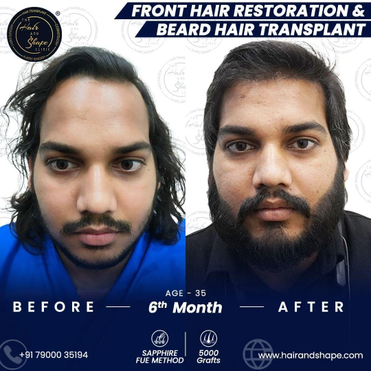 hair transplant before and after