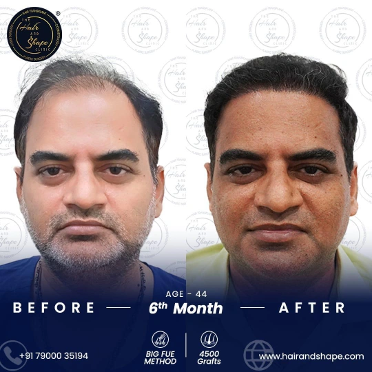 hair transplant before and after