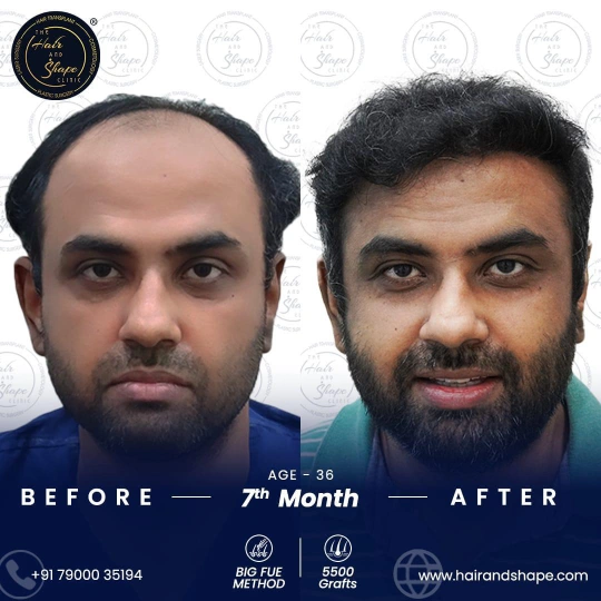 hair transplant before and after