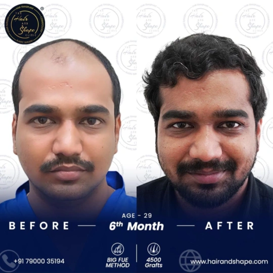 hair transplant before and after