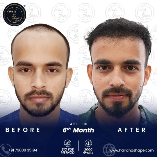 hair transplant before and after