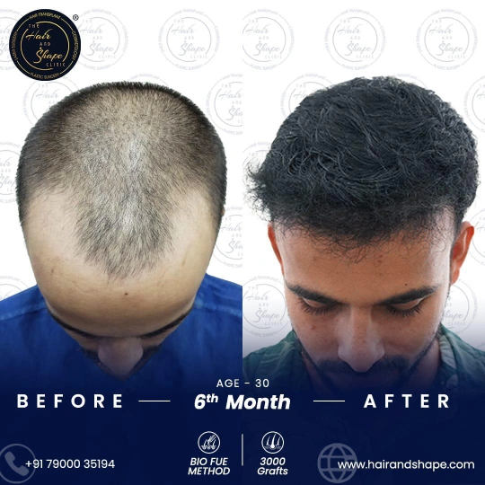 hair transplant before and after
