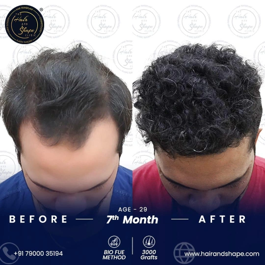 hair transplant before and after