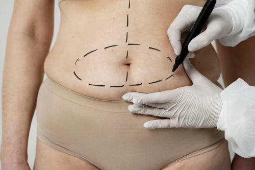 Liposuction