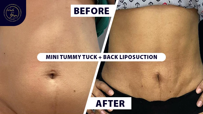Mini tummy tuck with back liposuction before & after