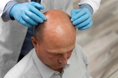 FUE Hair Transplant
