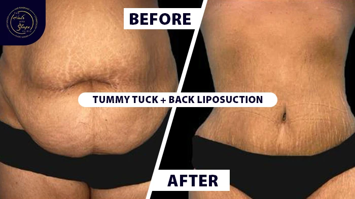 Tummy tuck with back liposuction before & after